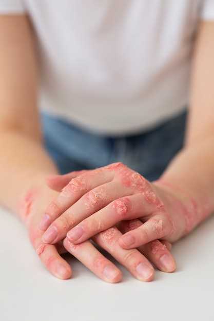 Диета и уход за кожей для снятия симптомов экземы на руках