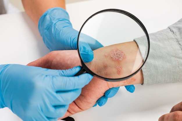 Симптомы грибковой инфекции на коже